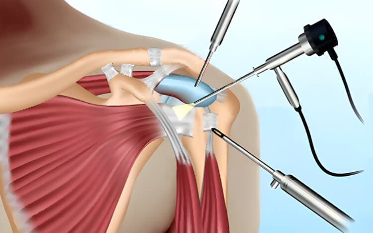 Artroscopia de rodilla y hombro
