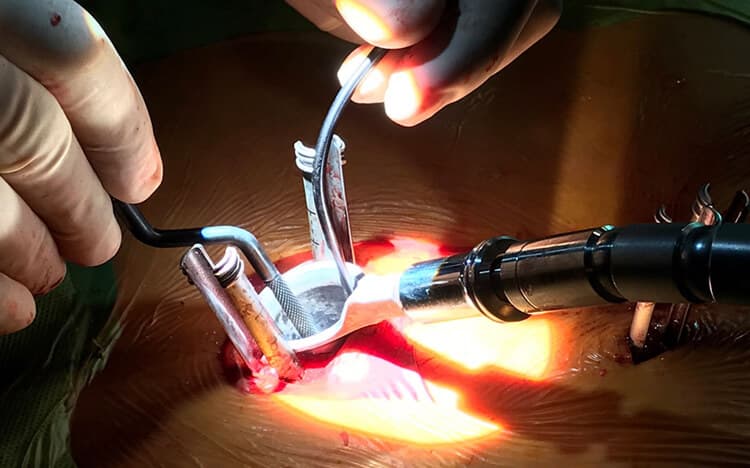 Cirugía de columna abierta y mínima invasión