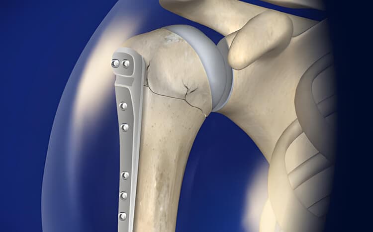 Reducción ortopédica de fracturas