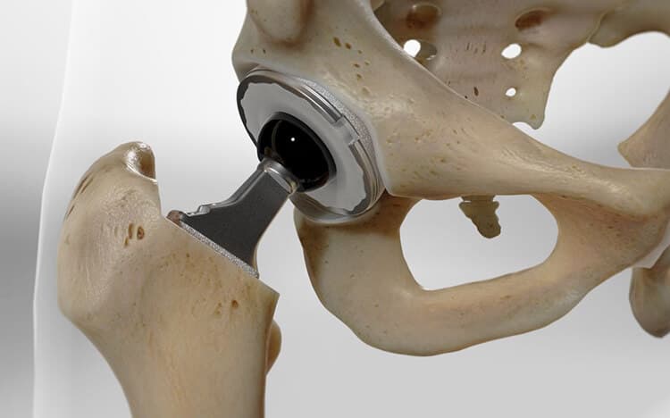 Reemplazo total de cadera