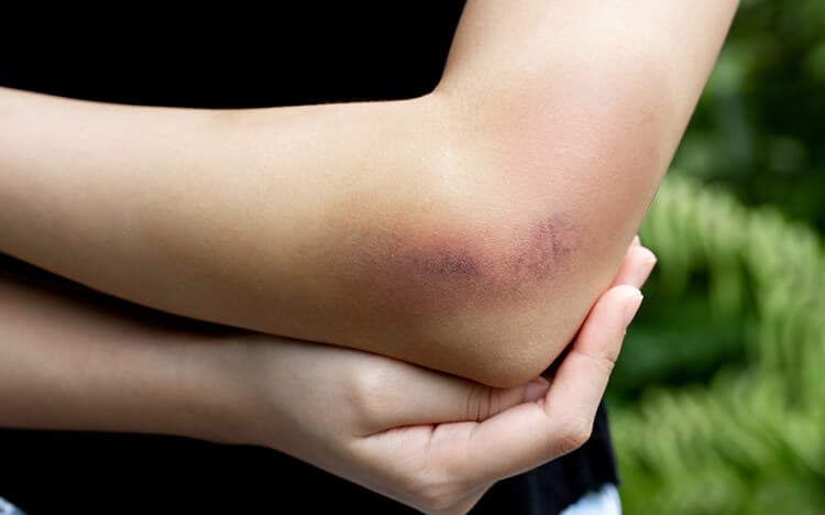 Inflamación o hinchazón en la zona afectada